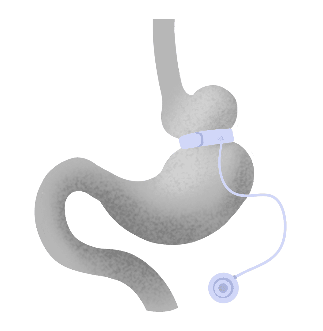 Banda gástrica ajustable para tratar la obesidad