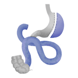 By Pass Duodeno-Ileal (SADI-S)