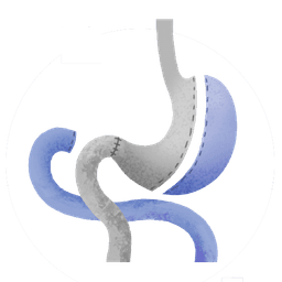 Switch Duodenal
